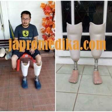 Kaki Palsu Bawah Lutut Bilateral