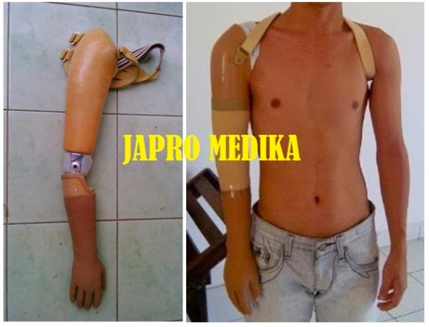 Tangan Palsu Atas Siku